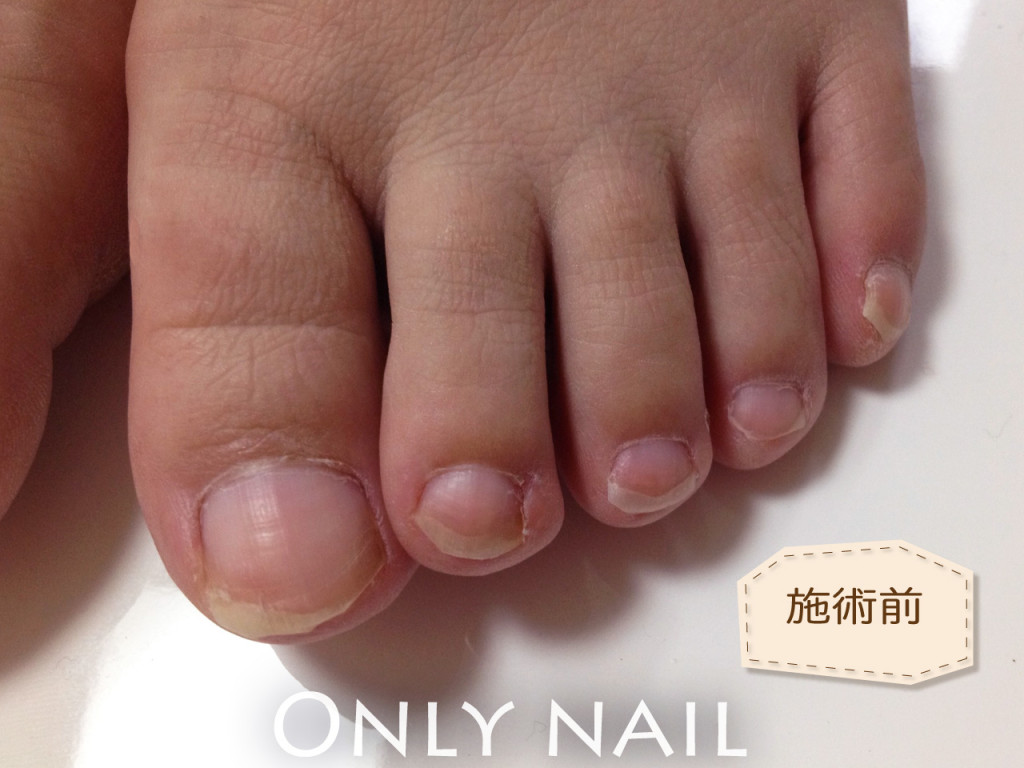 筑後市の自宅サロンでジェルネイル（フット）施術前